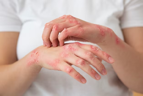Psoriasis, Eczema